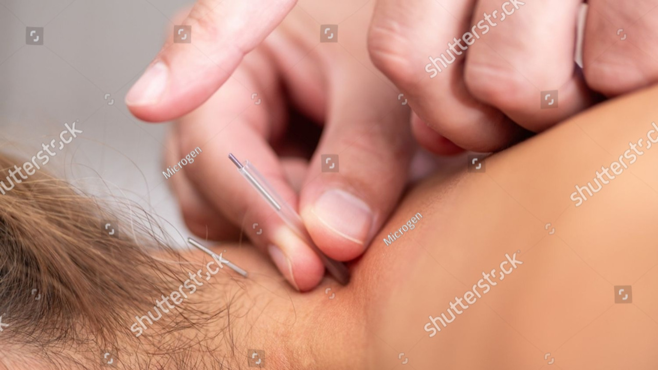 Fordelene ved nålebehandling/dry needling.
