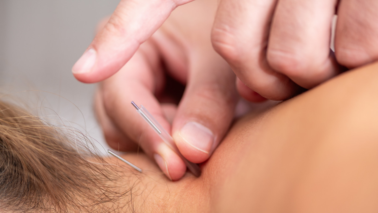 Fordelene ved nålebehandling/dry needling.